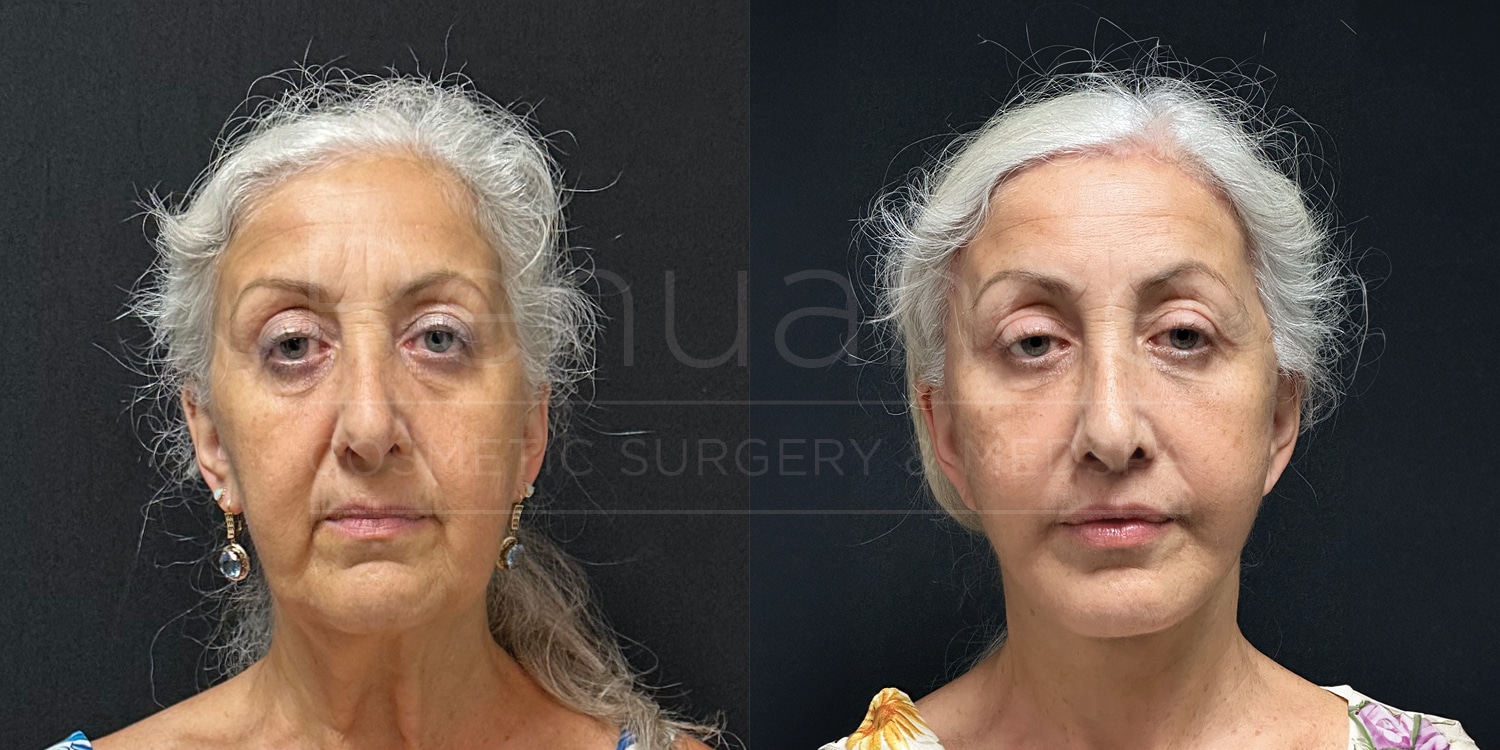 Deep Plane Face/neck Lift, Coronal Brow Lift, Lip Lift, Upper Blepharoplasty, Fat to Lip and Cheeks