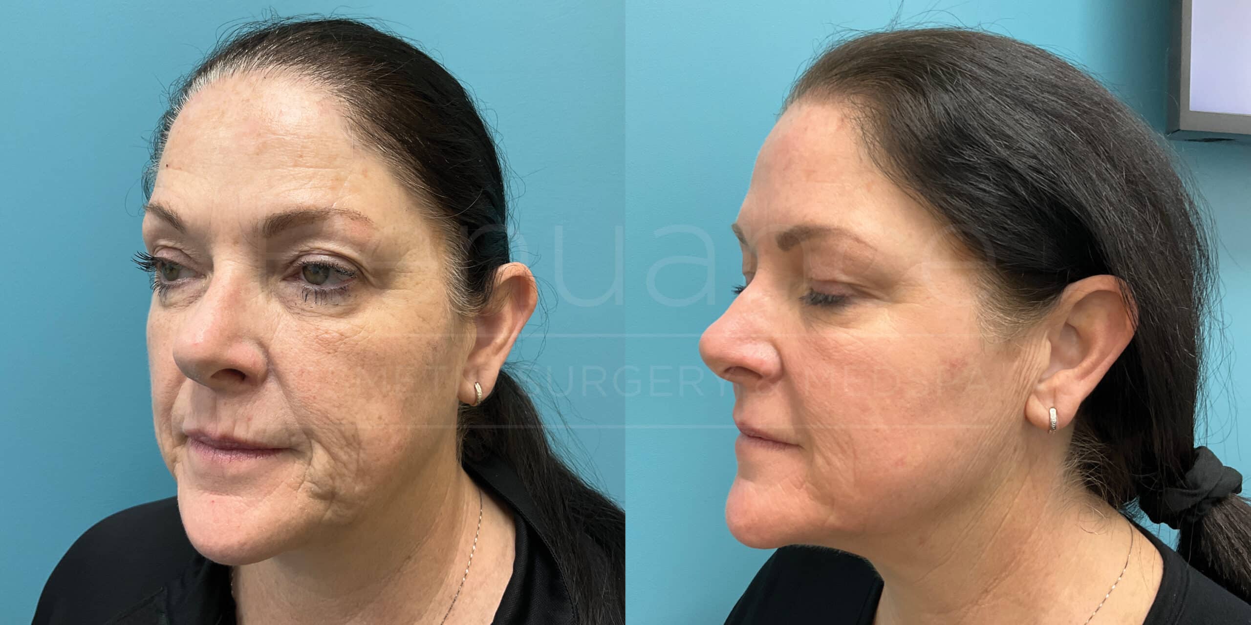 CO2 Laser Resurfacing
