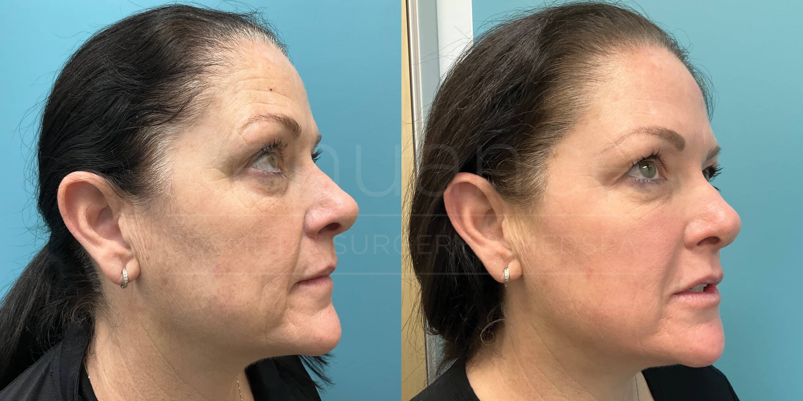 CO2 Laser Resurfacing