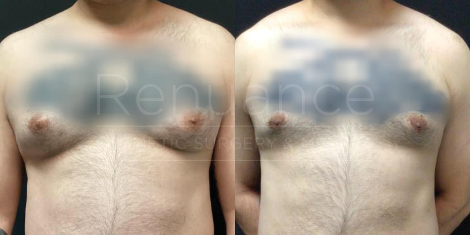 Renuance-Before&After-dr-Hill-Liposuction-and-Excision-for-gynecomastia