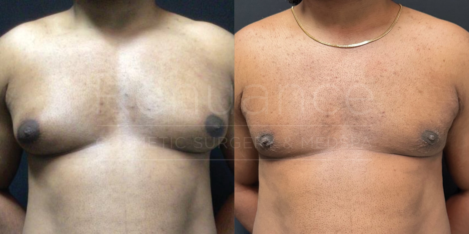 Renuance-Before&After-dr-Hill-Vaser Liposuction-and-excision-for-gynecomastia