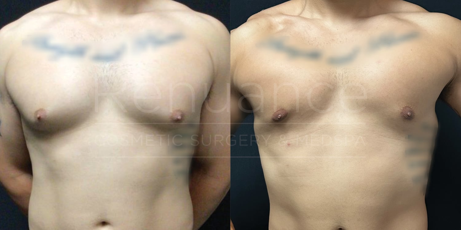 Renuance-Before&After-dr-Hill-Vaser-Liposuction-and-excision-of-bilateral-gynecomastia-under-local-with-oral-sedation-and-ProNox-11-06-2024