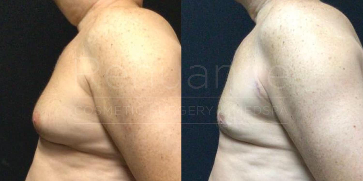 Renuance-Before&After-dr-Hill-Vaser-Liposuction-with-excision-for-gynecomastia- (2)