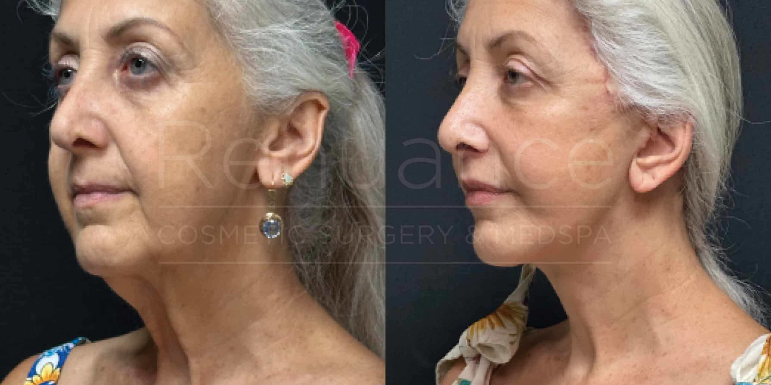 Deep Plane Face/neck Lift, Coronal Brow Lift, Lip Lift, Upper Blepharoplasty, Fat to Lip and Cheeks