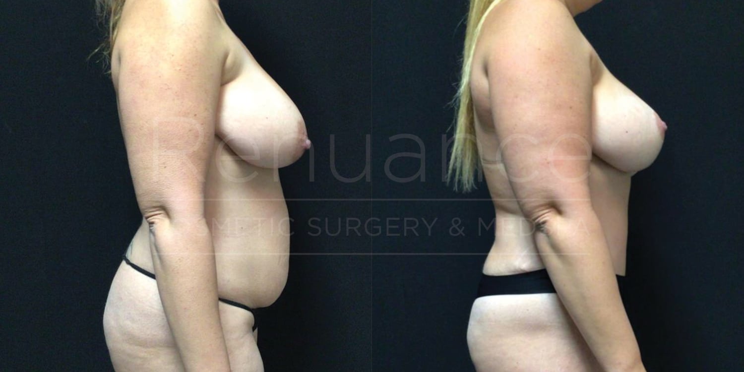 Abdominoplasty With Liposuction of the Abdomen & Flanks, Bilateral Mastopexies