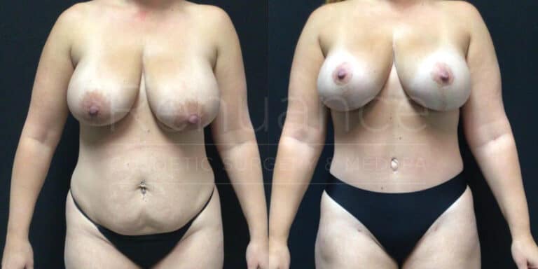 Abdominoplasty With Liposuction of the Abdomen & Flanks, Bilateral Mastopexies