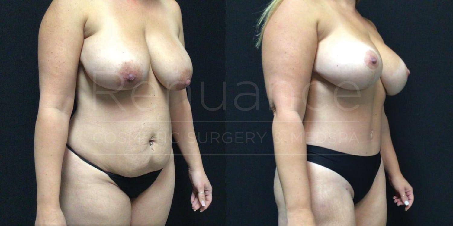 Abdominoplasty With Liposuction of the Abdomen & Flanks, Bilateral Mastopexies