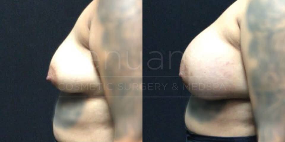 Bilateral Breast Augmentation, Right Crescent Mastopexy