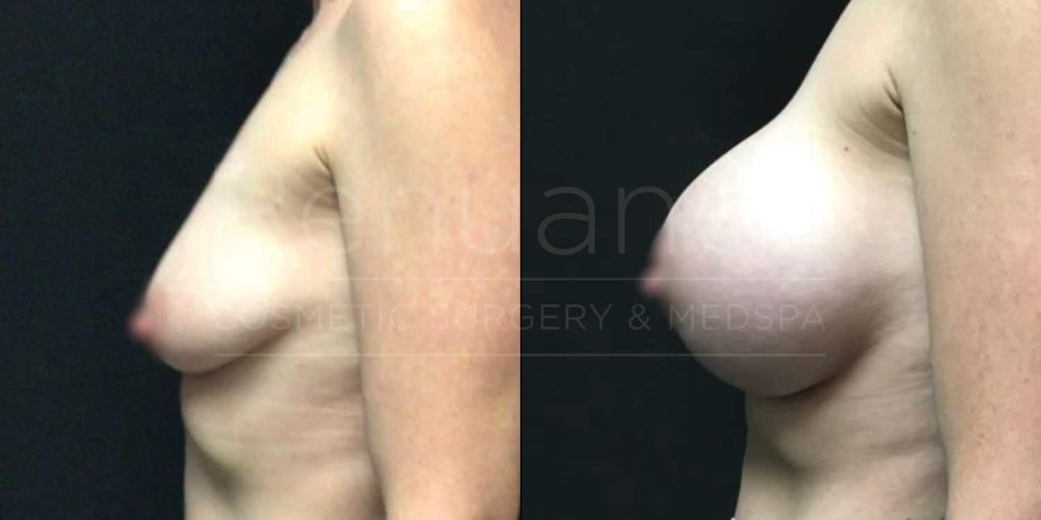 Bilateral Breast Augmentation