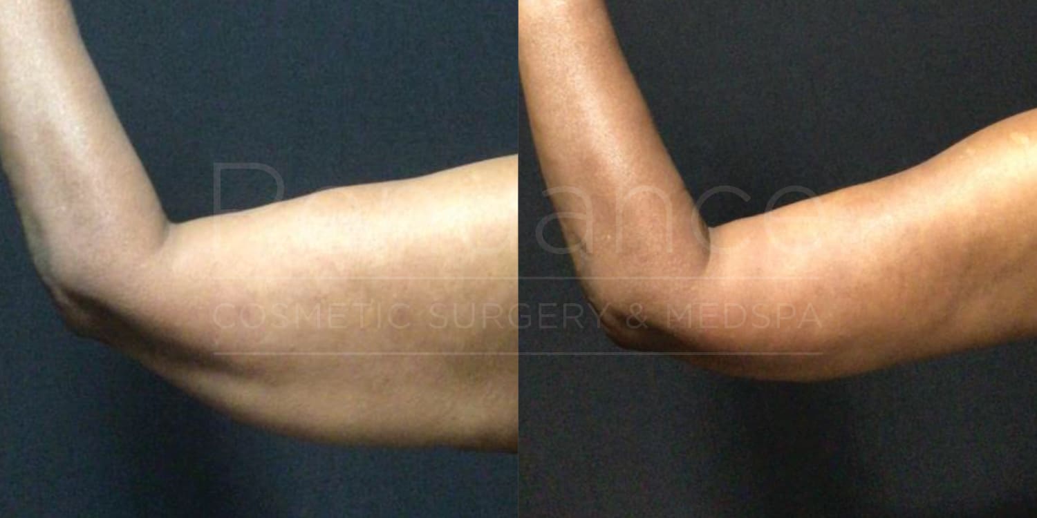 Brachioplasty