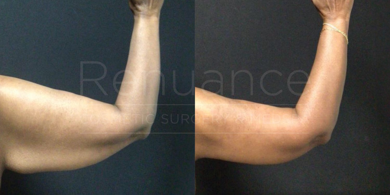 Brachioplasty