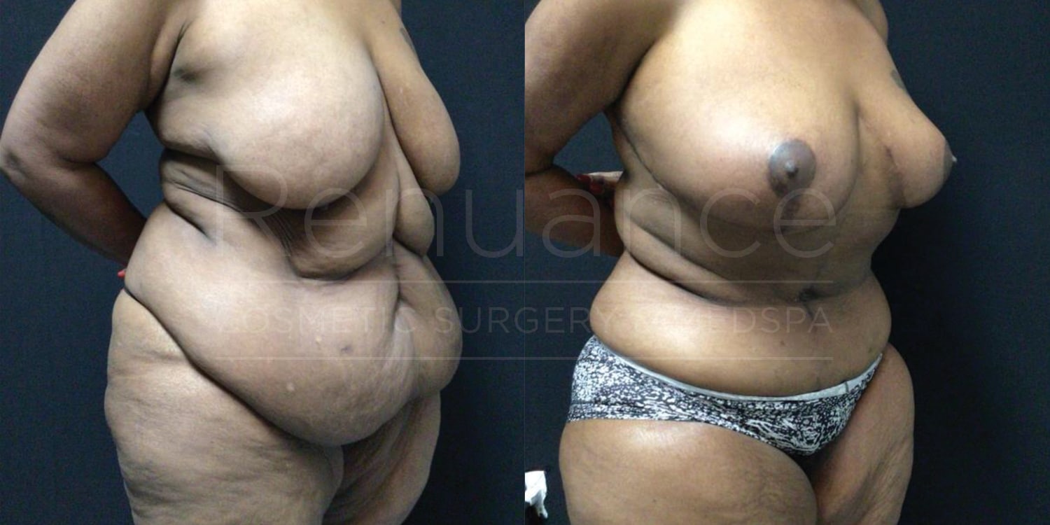 Fleur- de -lis abdominoplasty with liposuction of the abdomen & flanks, Bilateral Mastopexies with Renuvion