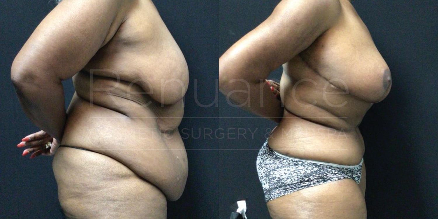 Fleur- de -lis abdominoplasty with liposuction of the abdomen & flanks, Bilateral Mastopexies with Renuvion