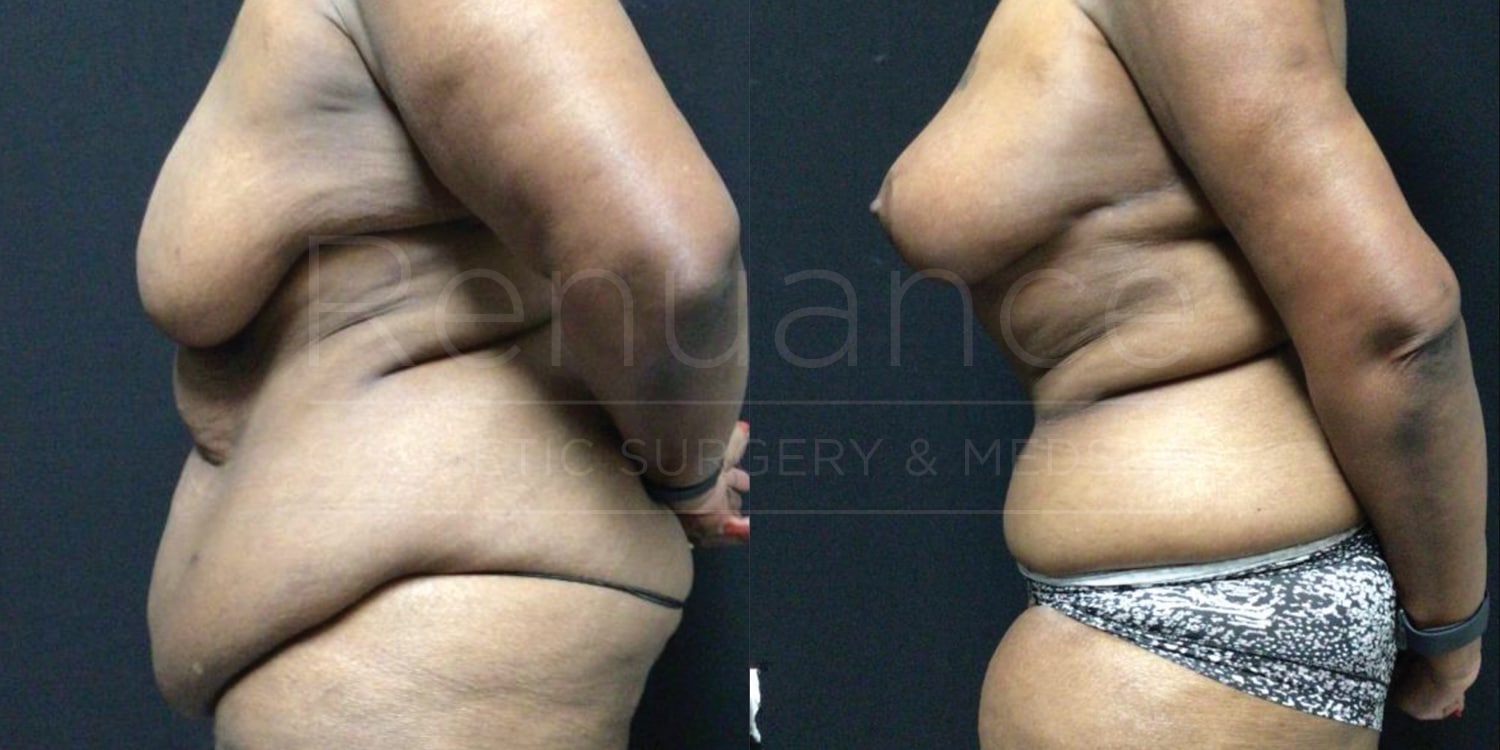 Fleur- de -lis abdominoplasty with liposuction of the abdomen & flanks, Bilateral Mastopexies with Renuvion