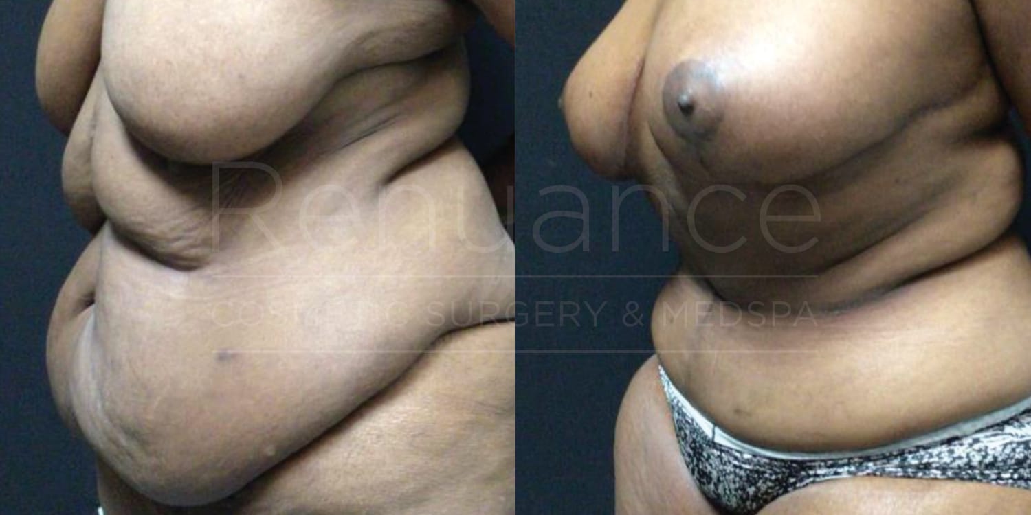 Fleur- de -lis abdominoplasty with liposuction of the abdomen & flanks, Bilateral Mastopexies with Renuvion