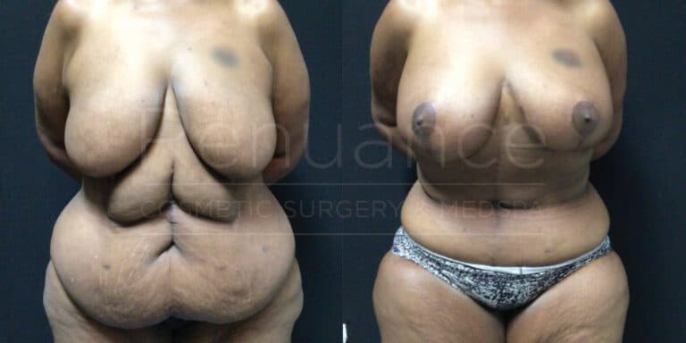 Fleur- de -lis abdominoplasty with liposuction of the abdomen & flanks, Bilateral Mastopexies with Renuvion