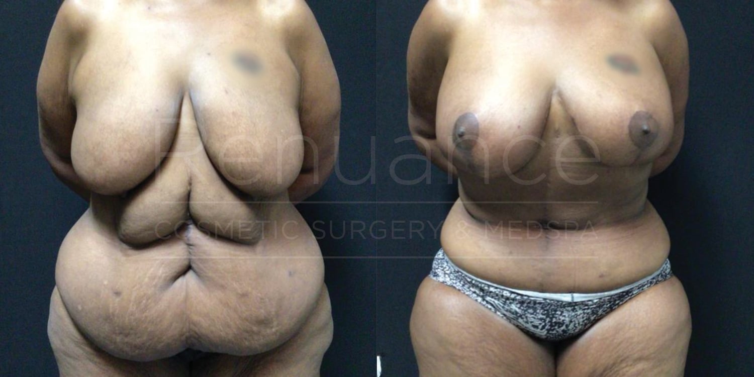 Fleur- de -lis abdominoplasty with liposuction of the abdomen & flanks, Bilateral Mastopexies with Renuvion