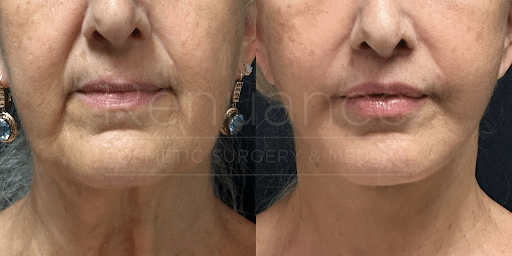 lip lift results before and after