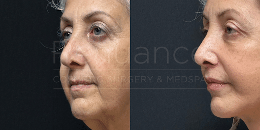 before and after a lip lift procedure