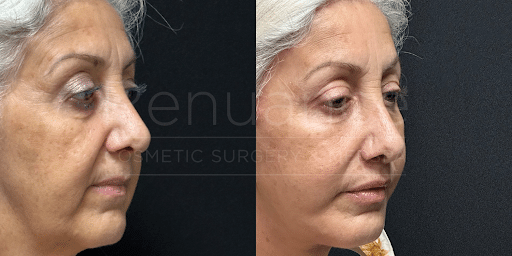 patient before and after a lip lift