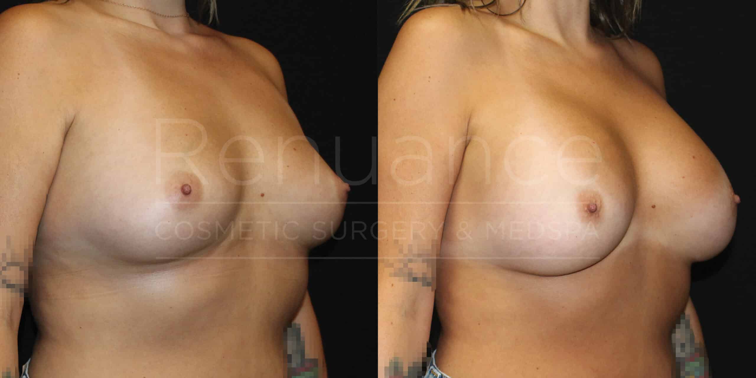 renuance ford female breast augmentation