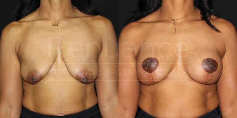 renuance ford female breast lift with implants