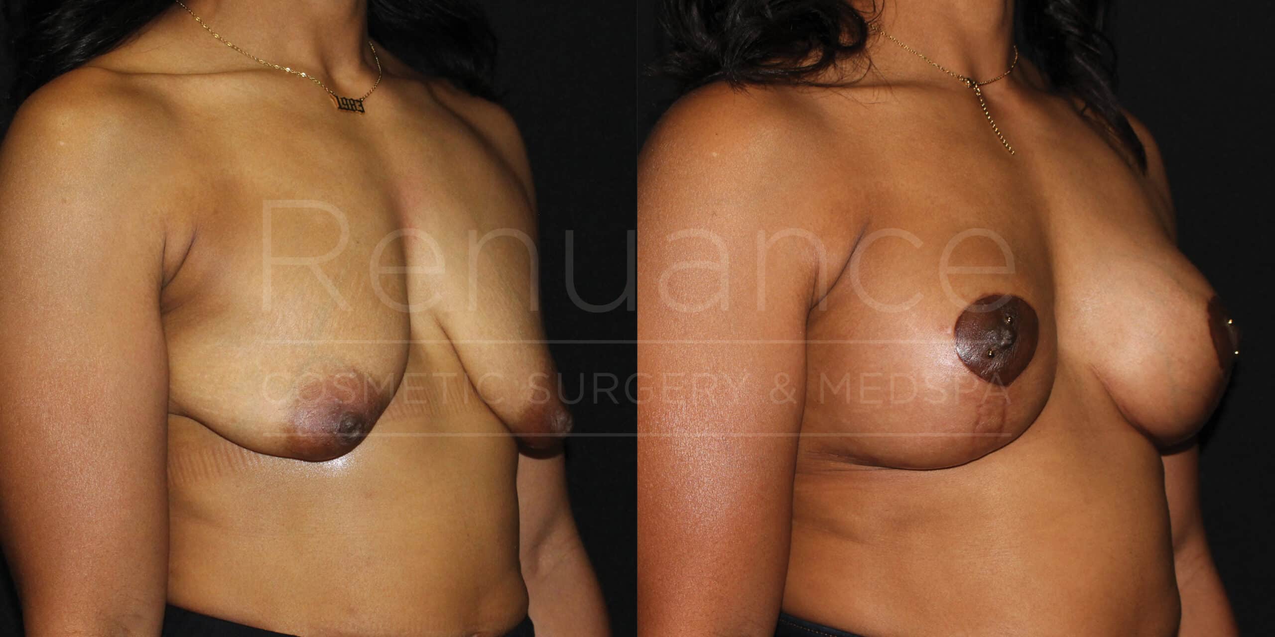 renuance ford female breast lift with implants
