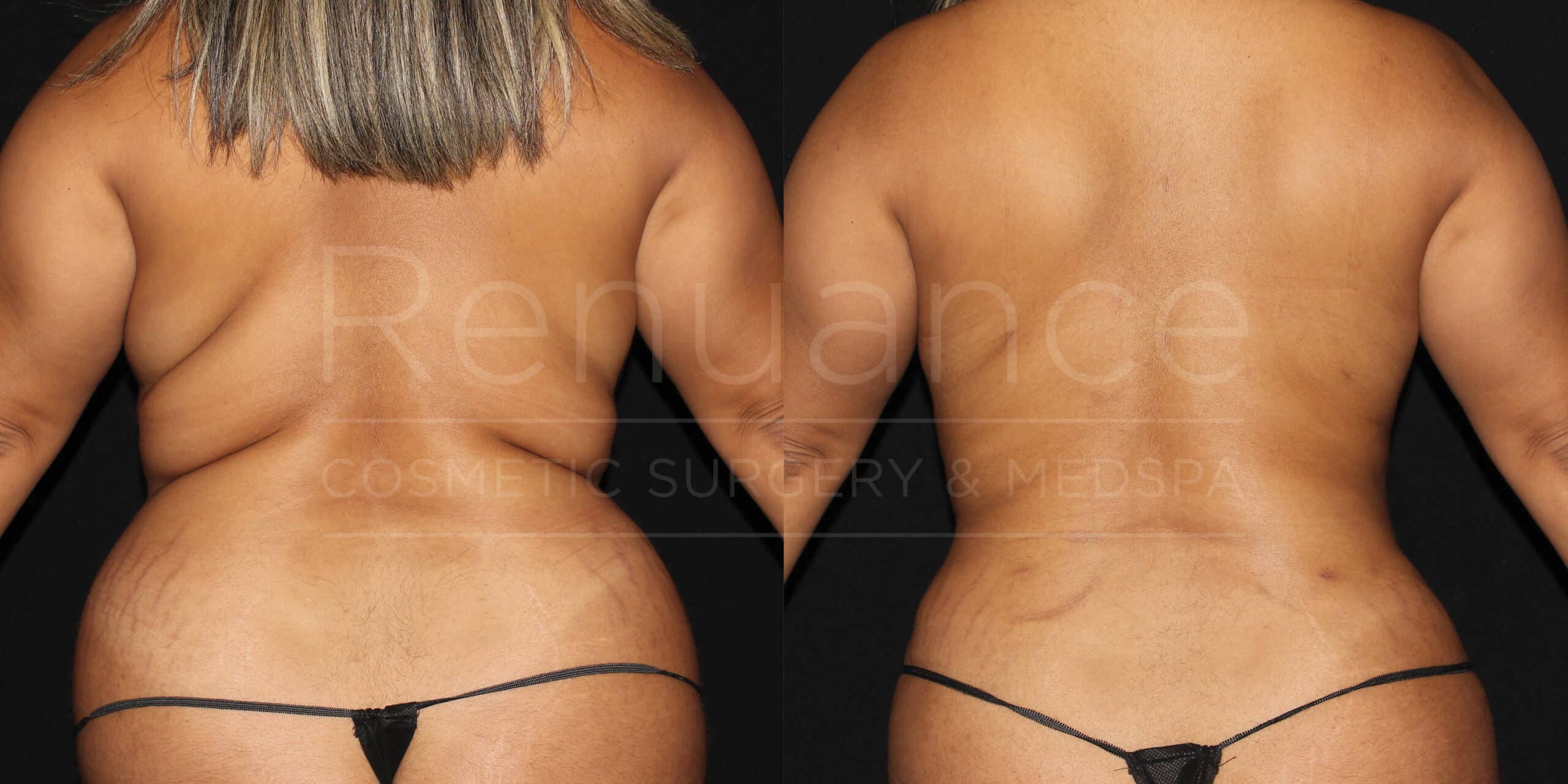 renuance ford female back lipovaser vaser