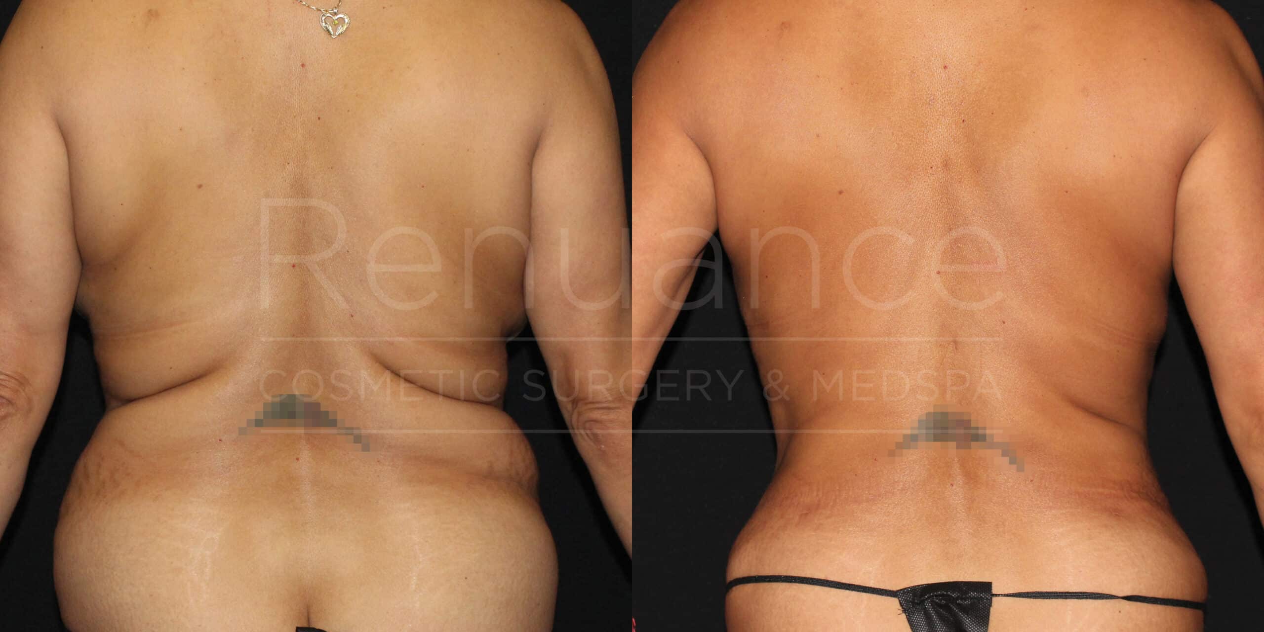 renuance ford female back liposuction