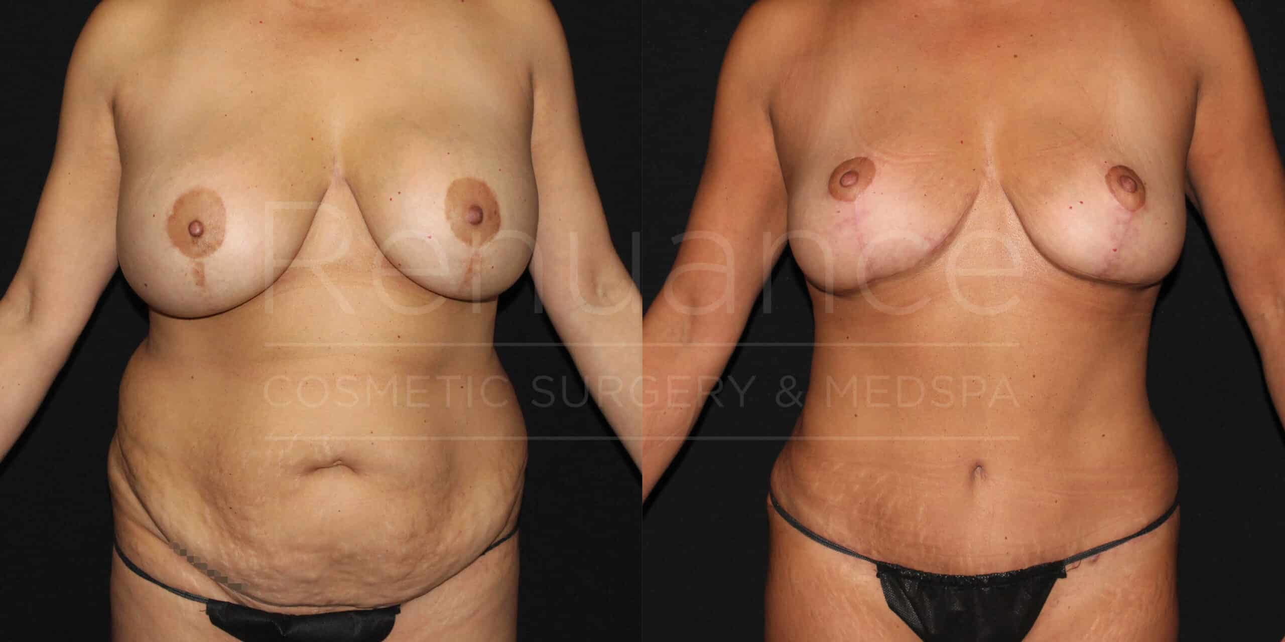 renuance ford female body mommy makeover