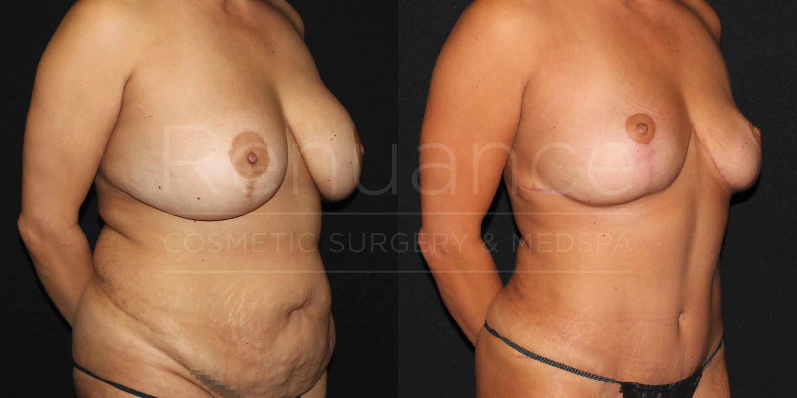 renuance ford female body mommy makeover