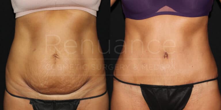 renuance ford female body tummy tuck