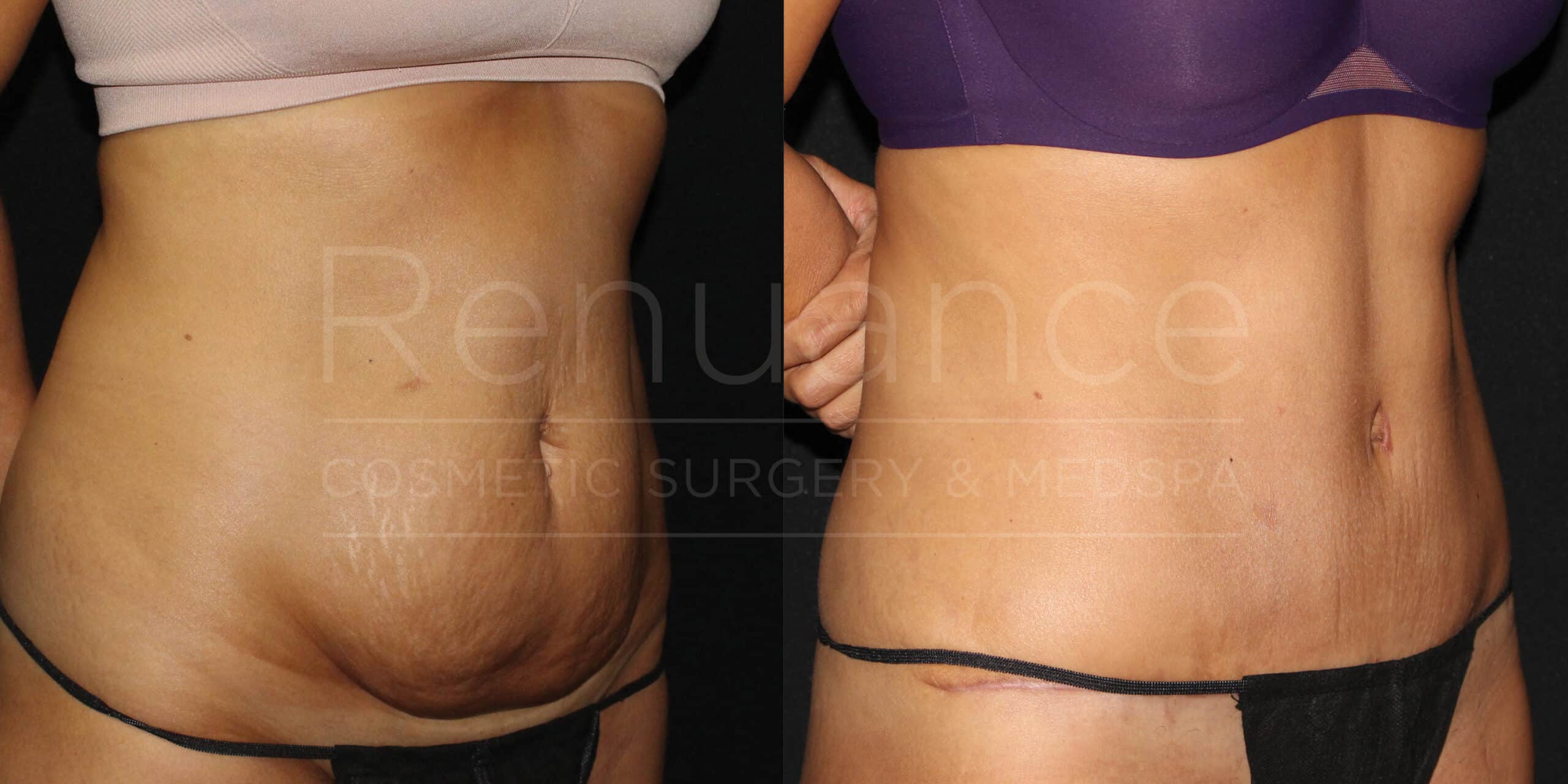 renuance ford female body tummy tuck