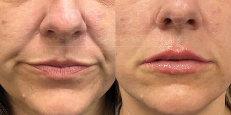 renuance delaney juvaderm Hyaluronic Acid lip filler