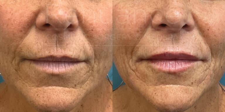 renuance delaney juvaderm Hyaluronic Acid lip filler