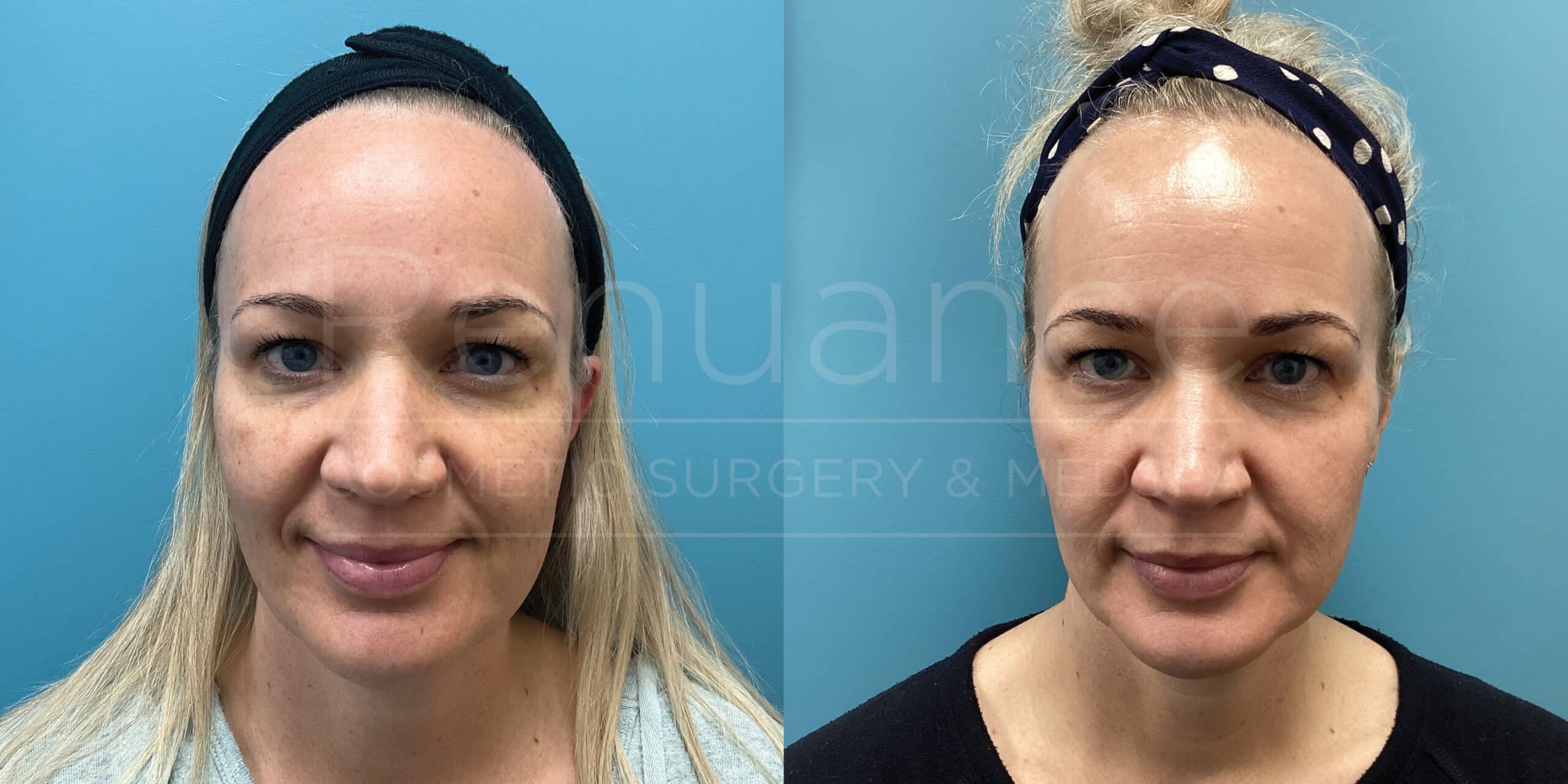 A woman before and after the Elos IPL Photofacial + RF Laser treatment at Renuance with Dr Debbie