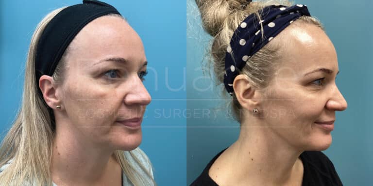 A woman before and after the Elos IPL Photofacial + RF Laser treatment at Renuance with Dr Debbie