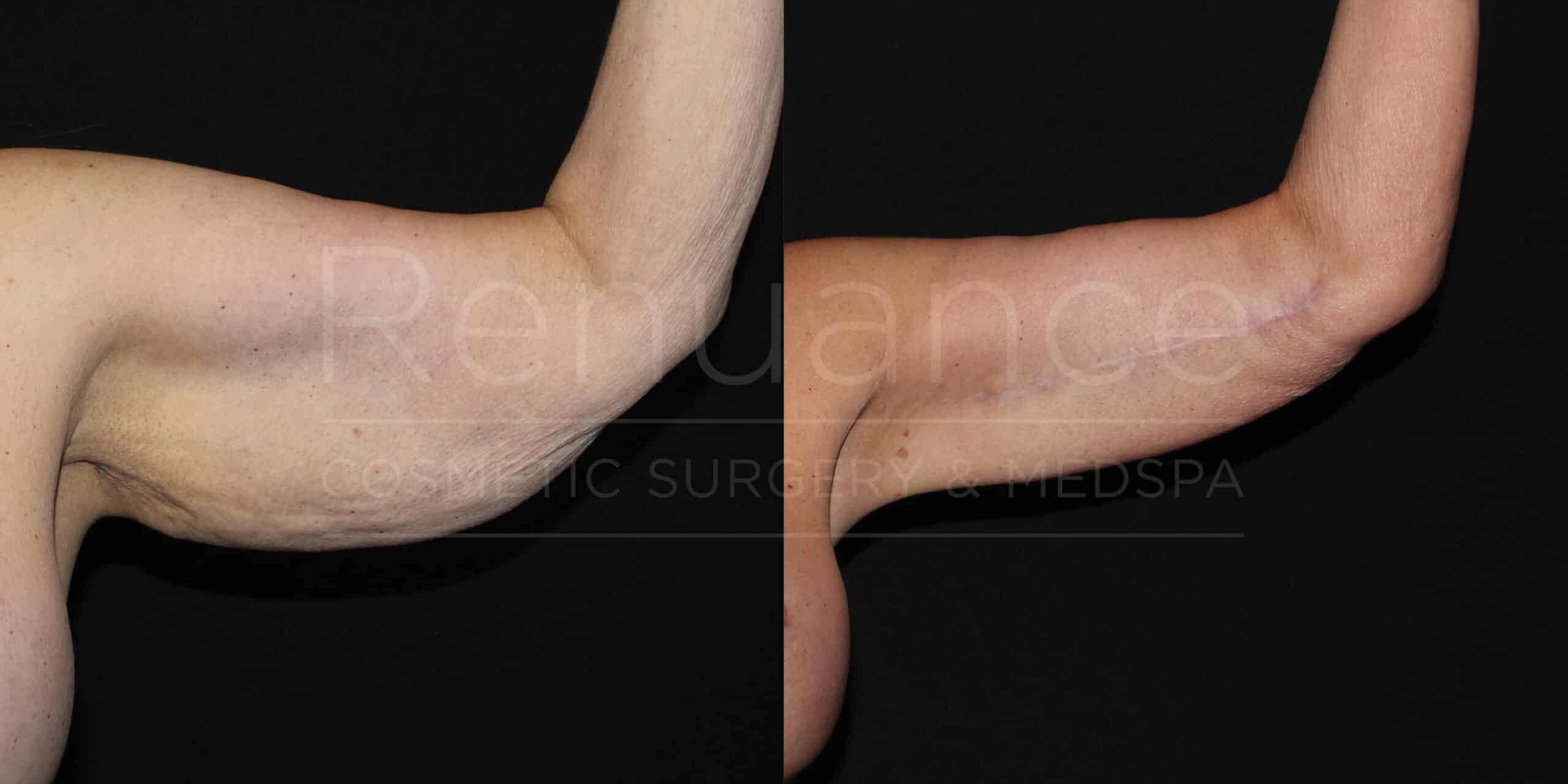Brachioplasty Before and After Photos