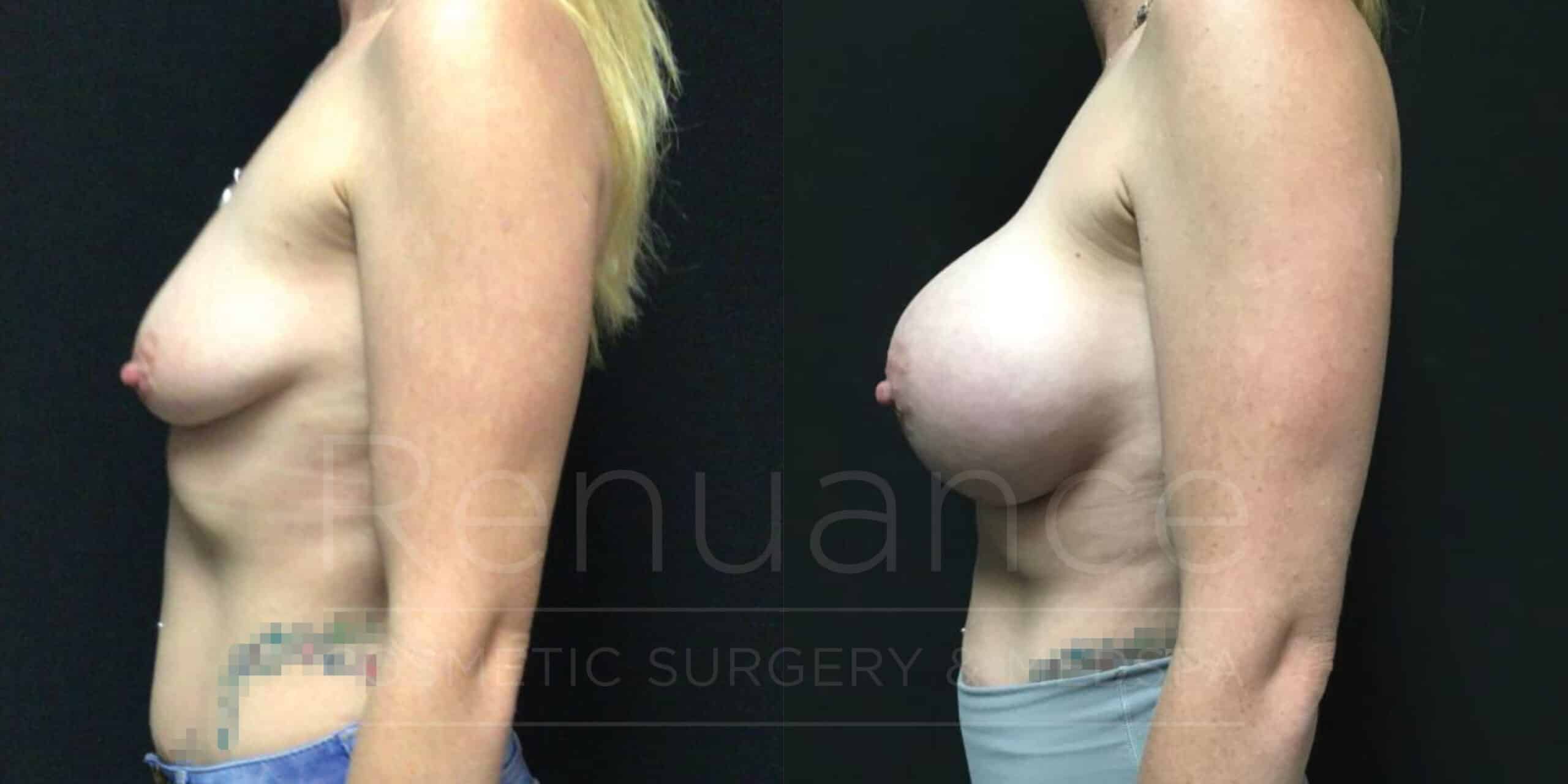Breast Lift and Augmentation Before and After