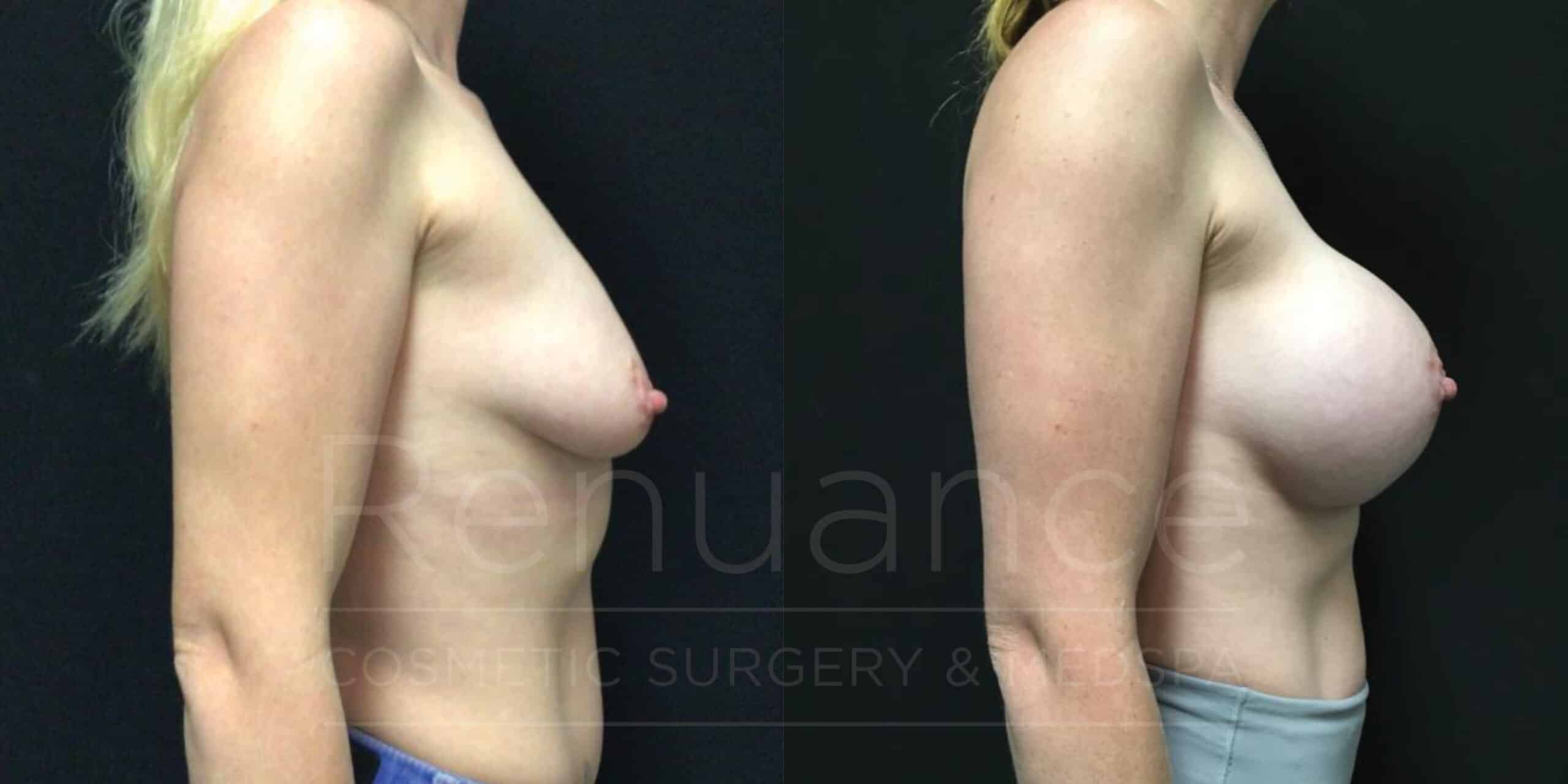 Breast Lift and Augmentation Before and After