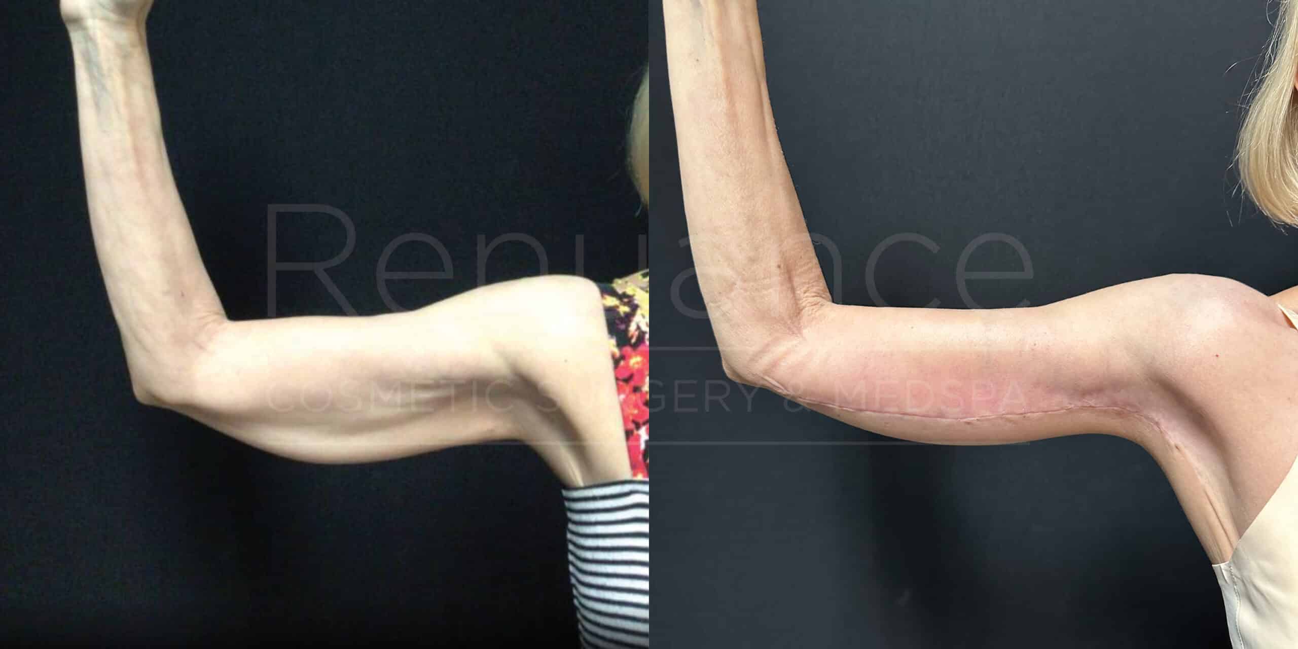 Brachioplasty Before and After