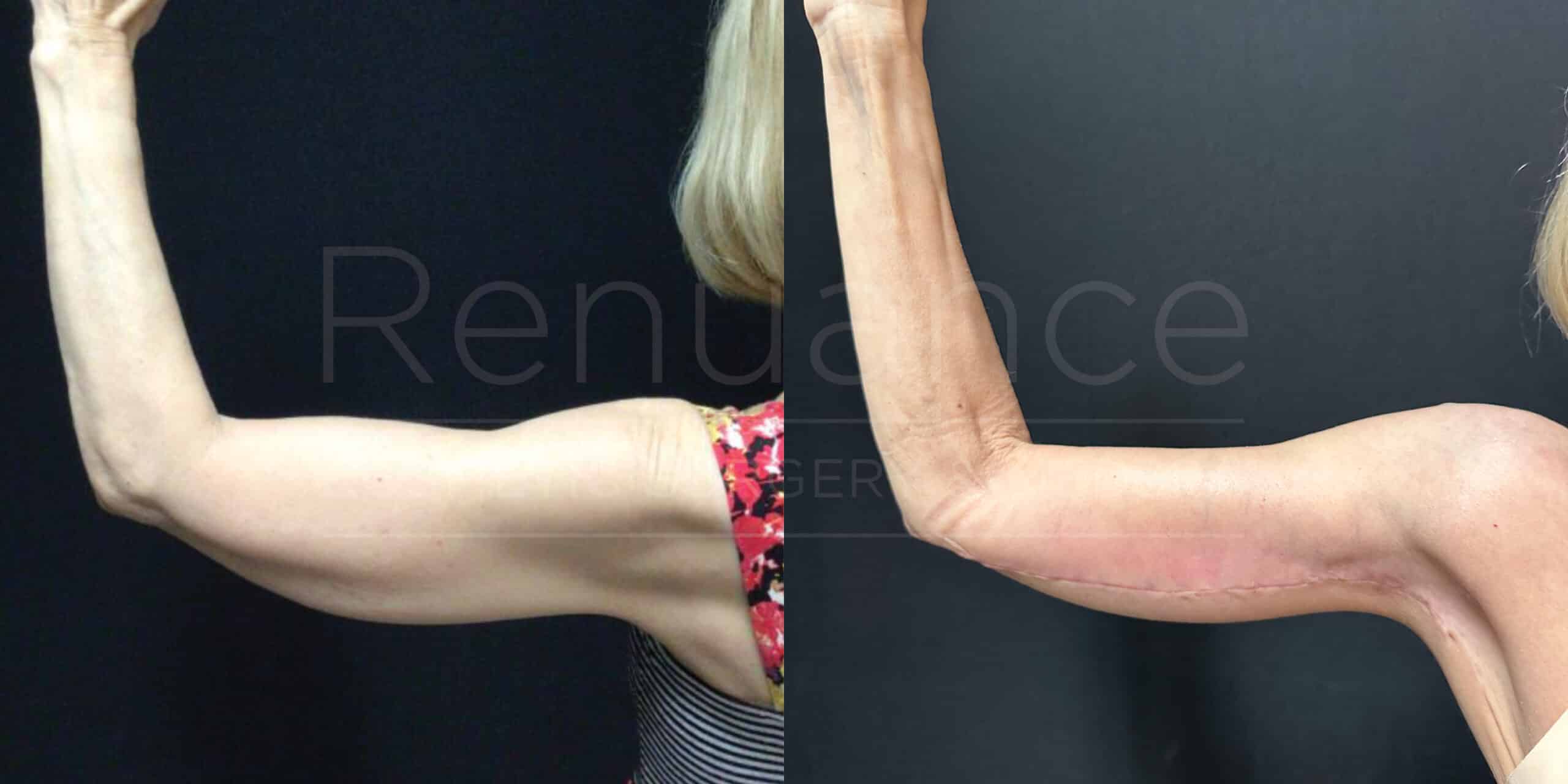 Brachioplasty Before and After