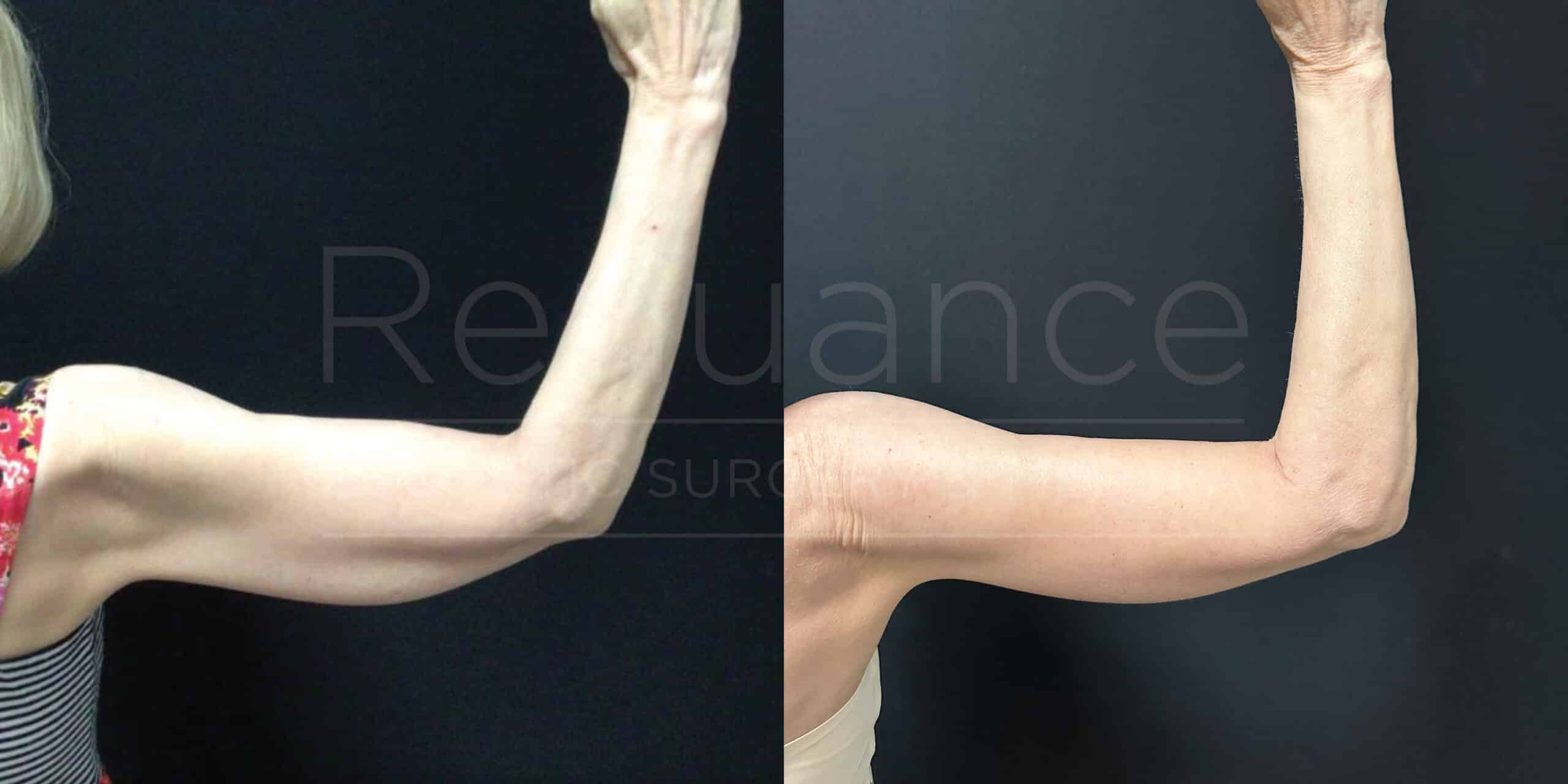 Brachioplasty Before and After