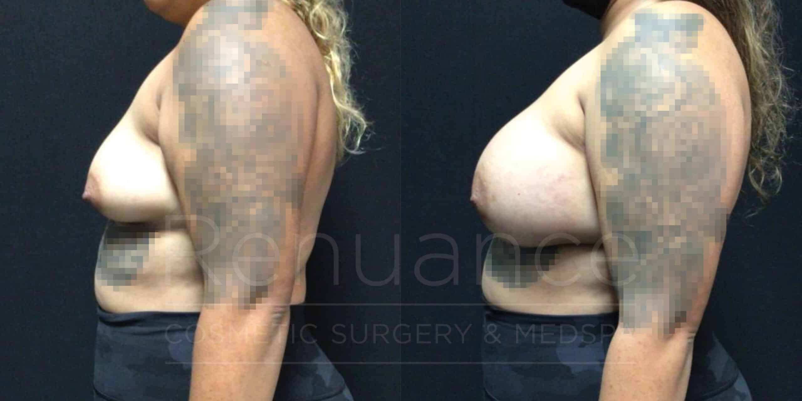 Breast Augmentation Before and After Photos