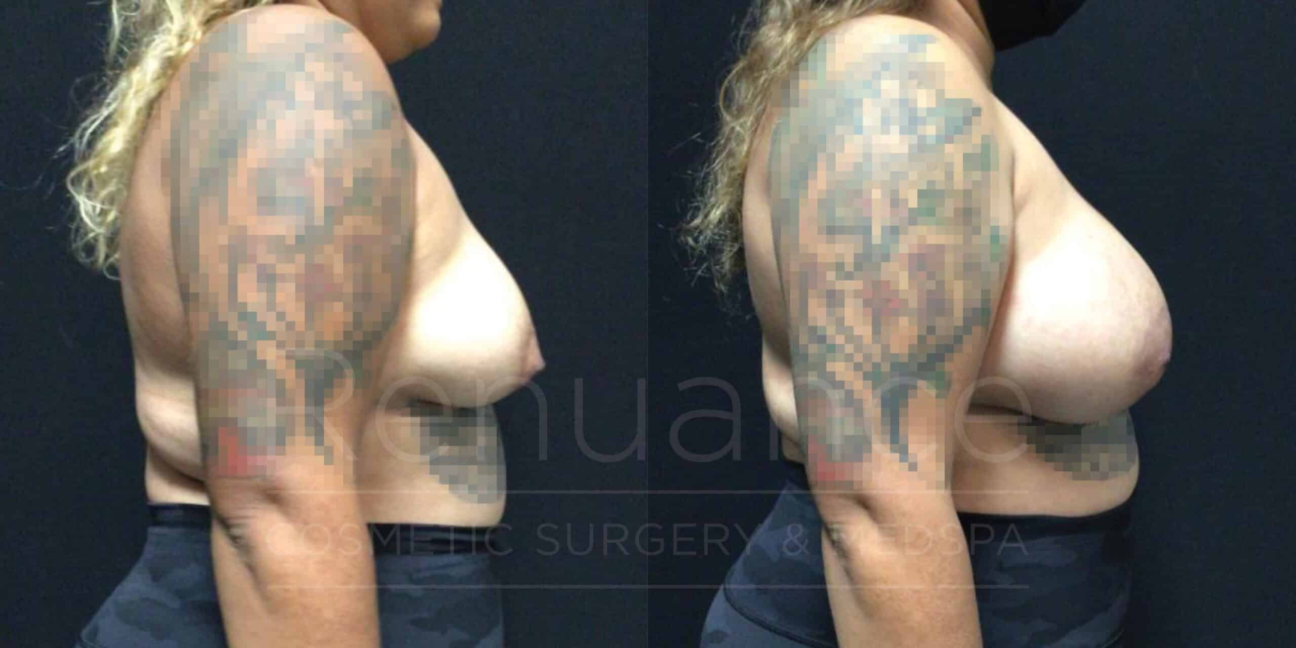 Breast Augmentation Before and After Photos