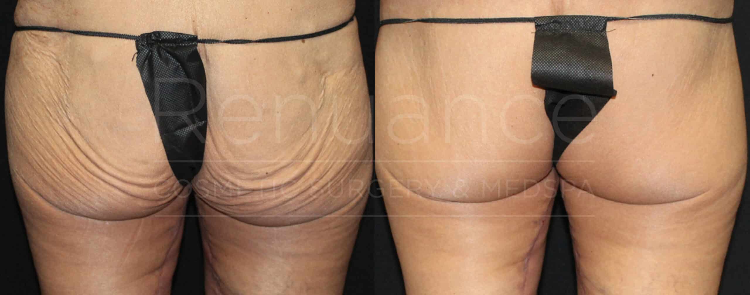 renuance dr ford skin tightening after weight loss