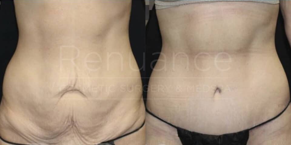 renuance dr ford skin tightening after weight loss