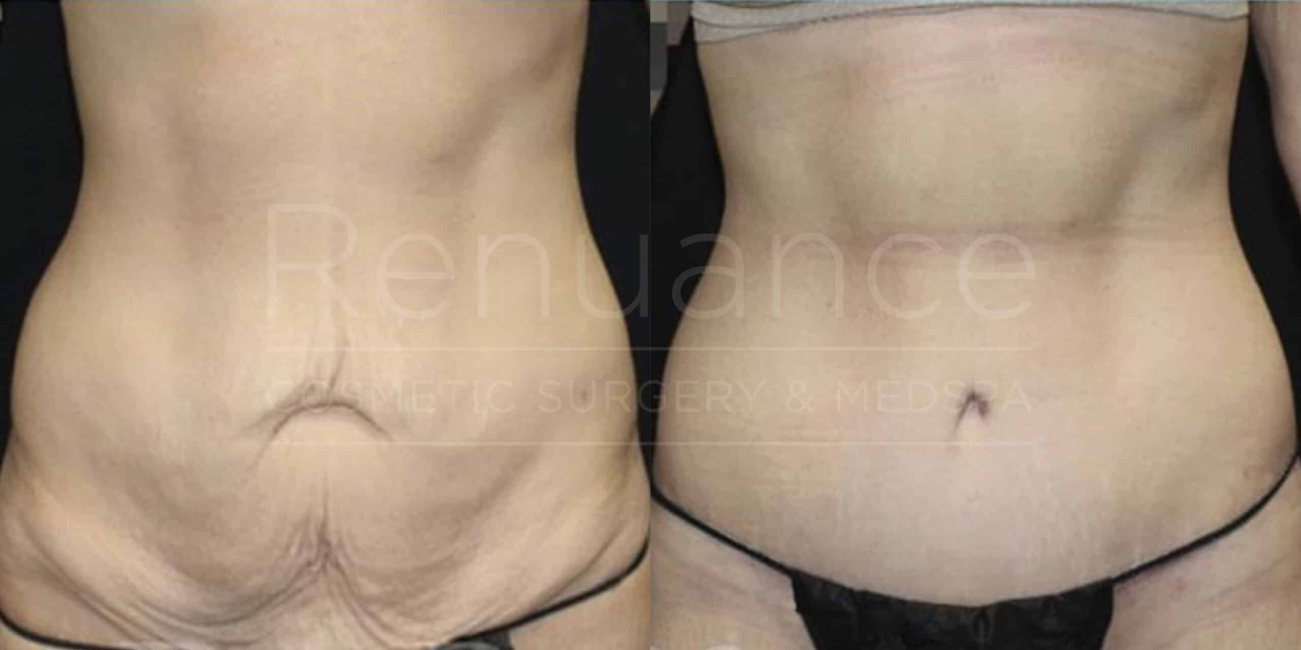 renuance dr ford skin tightening after weight loss