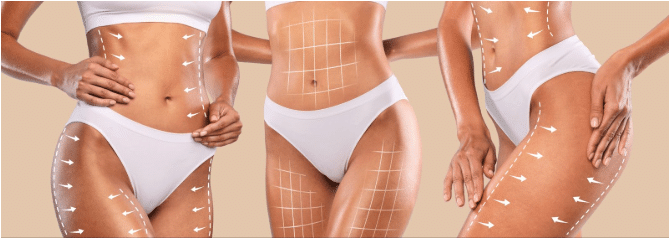 How to Decide Between a Tummy Tuck and a Body Lift