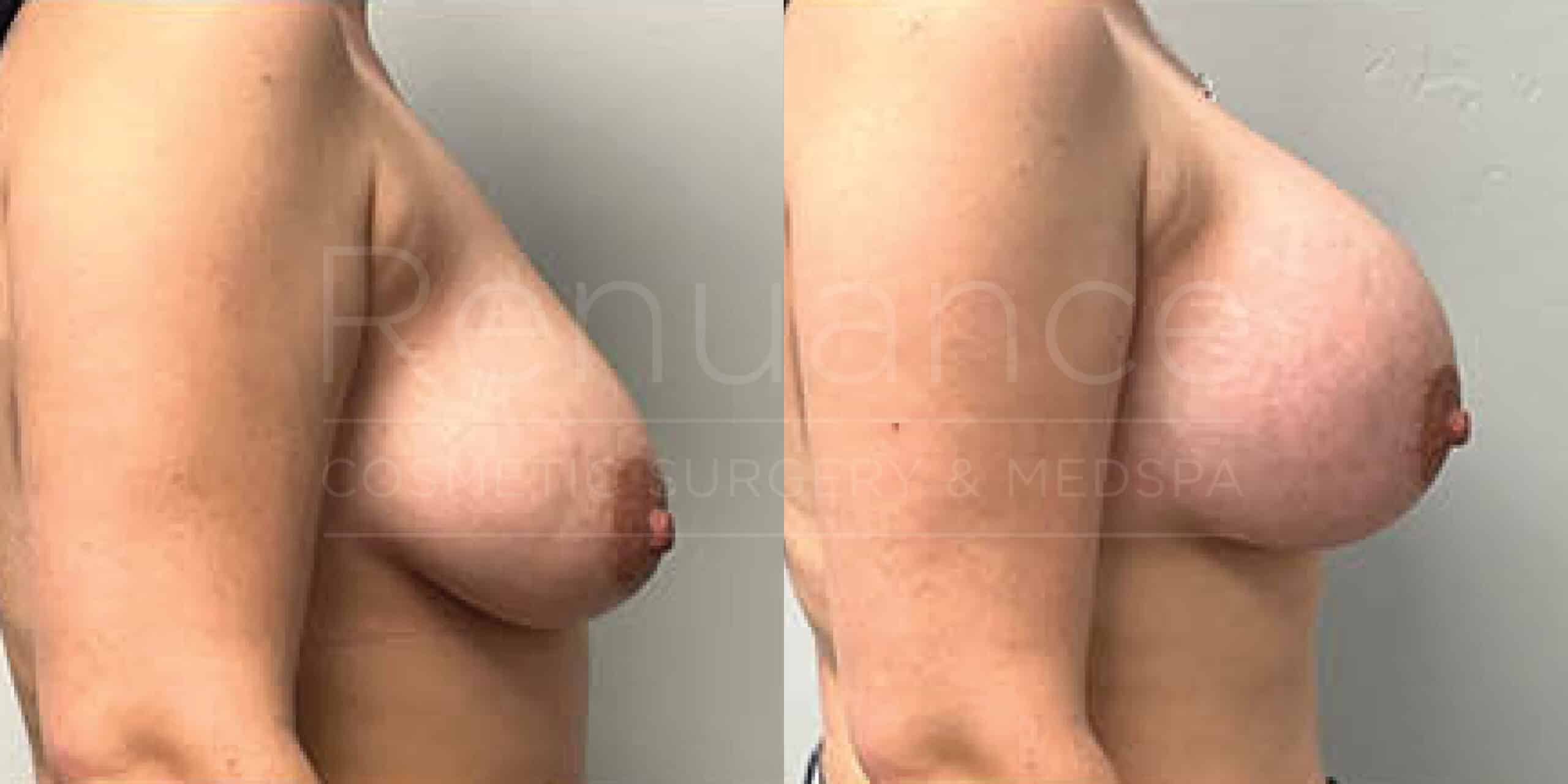 Before/After Breast Augmentation